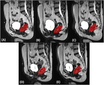 Feasibility of delta radiomics–based pCR prediction for rectal cancer patients treated with magnetic resonance–guided adaptive radiotherapy